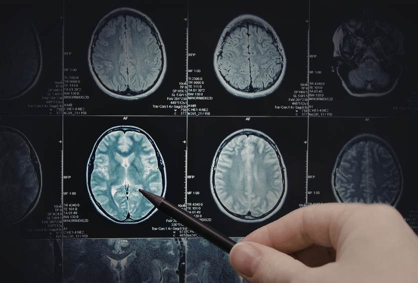 Brain Metastases: How Neurosurgeons Manage Tumors That Spread to the Brain