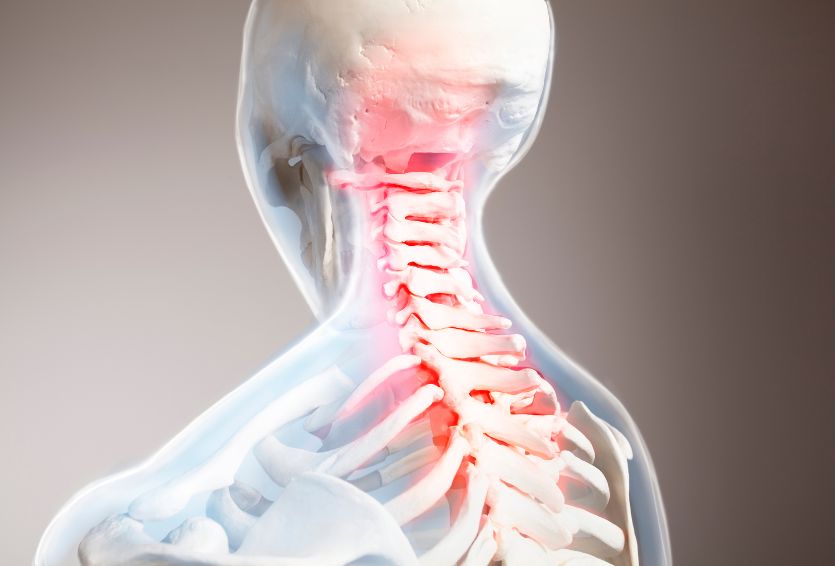 How a Neurosurgeon Evaluates and Treats Cervical Radiculopathy