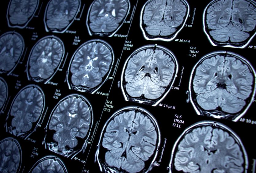 When to Consider Brain Surgery for Epilepsy: What Patients Should Expect