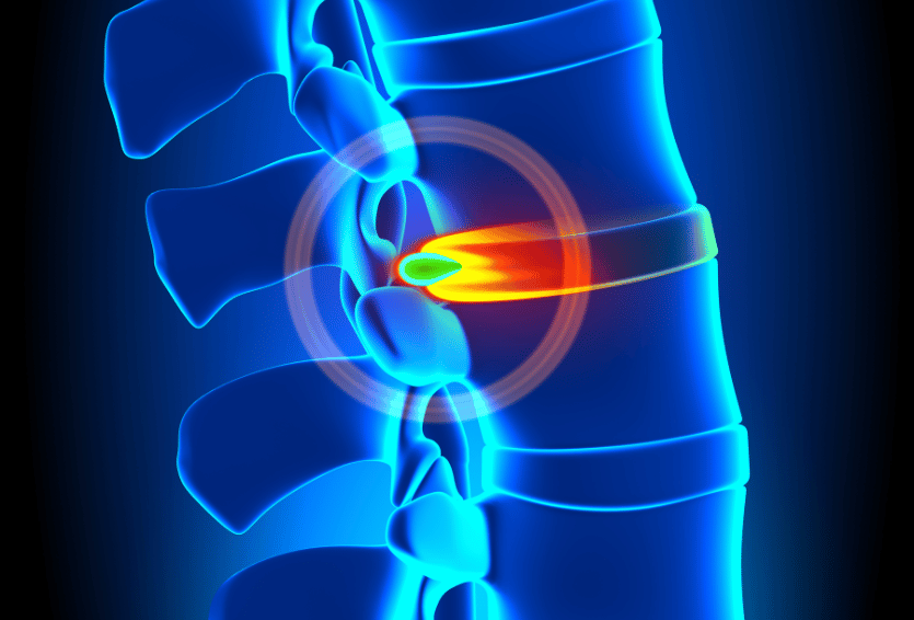 Non-Operative Treatment of Lumbar Degenerative Disc Disease (DDD)