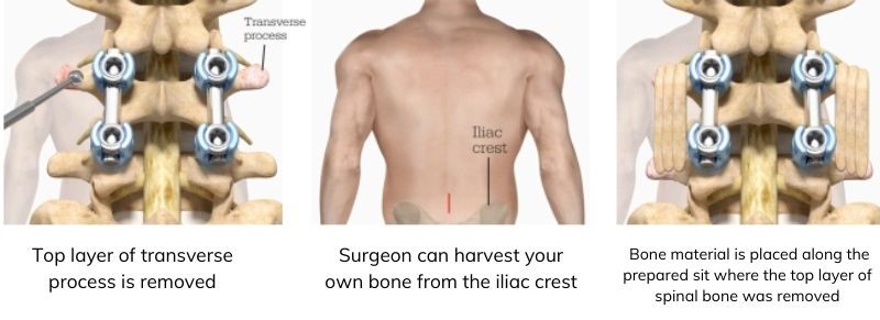 THORACOLUMBAR LAMINECTOMY AND FUSION