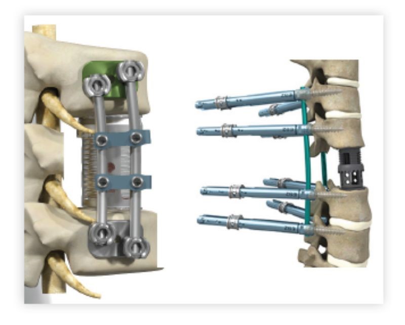 Thoracolumbar Vertebral Body Replacement - Step 4
